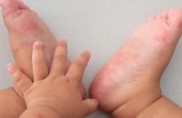 Dấu hiệu cảnh báo bệnh tay chân miệng ở trẻ